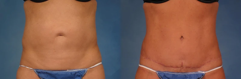 How Long After Liposuction Should You Wait?