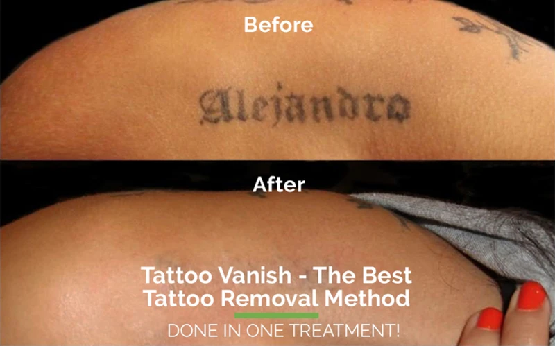 Alternatives To Tattoo Removal