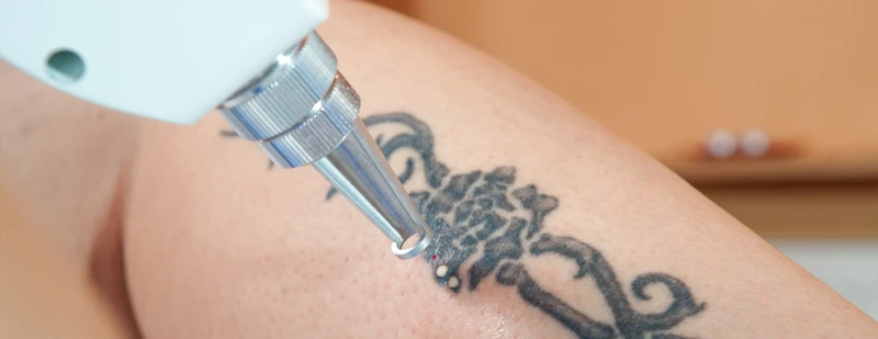 Benefits Of Laser Tattoo Removal