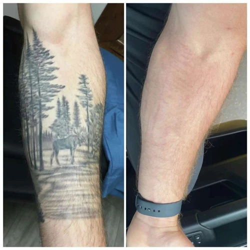 Benefits Of Removing Tattoos Without Laser