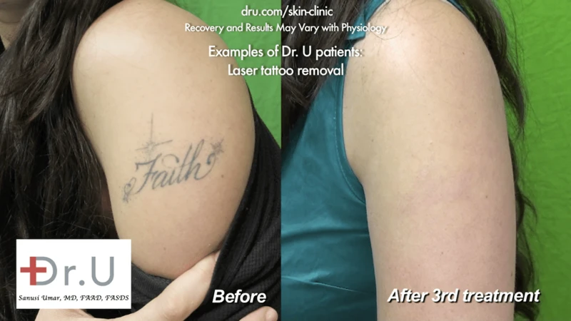 Choose A Professional Tattoo Removal Provider
