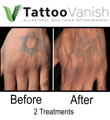 Considerations For Natural Tattoo Removal