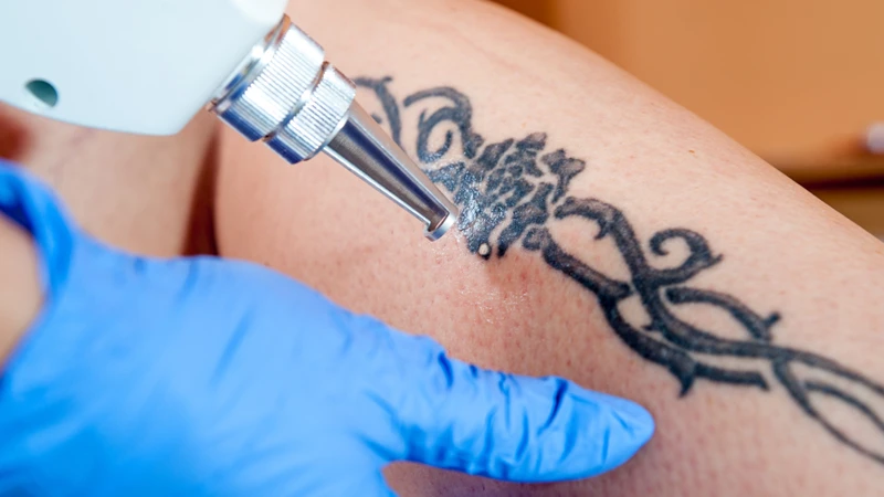 Costs Of Tattoo Removal