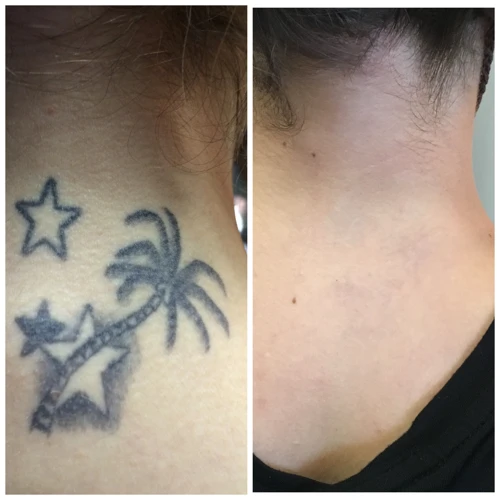 Factors Affecting Tattoo Removal Time