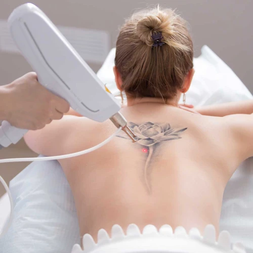 History Of Tattoo Removal