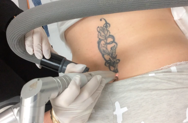 How Badly Does Tattoo Removal Hurt?