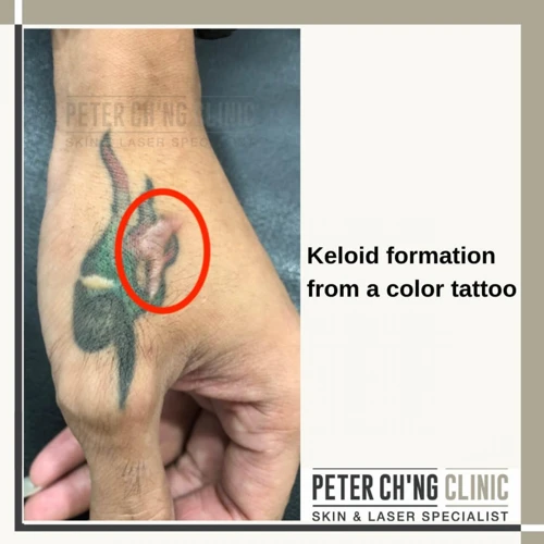 How Do You Know If Your Tattoo Will Keloid?