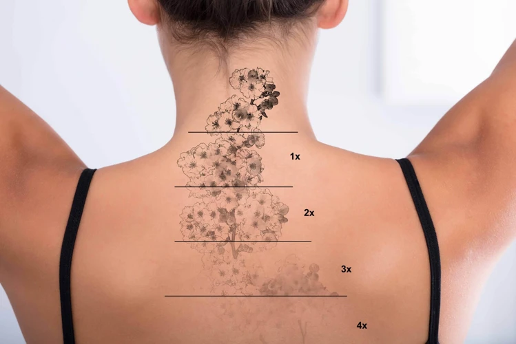 How Long Does Laser Tattoo Removal Take?