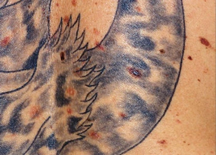 How Tattooing Affects Moles