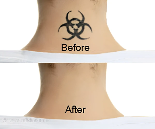 How To Remove A Tattoo With Salt And Ice