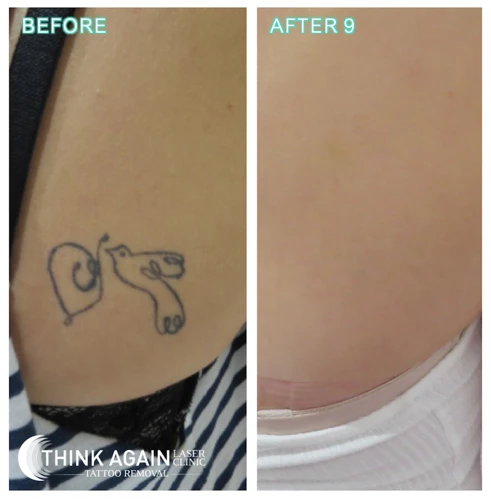How To Speed Up Tattoo Removal
