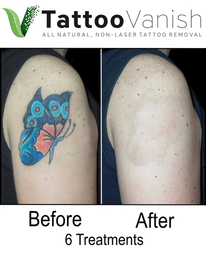 Natural Tattoo Removal Methods