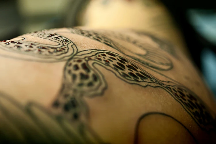 Overview Of Tattoo Scarring