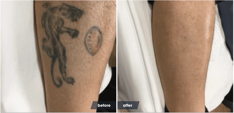 Pre-Laser Tattoo Removal