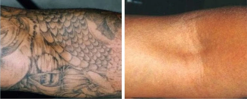 Safety And Risks Of Laser Tattoo Removal