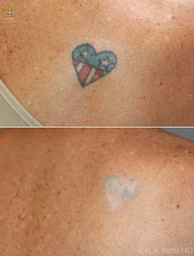 Tips For Removing A Tattoo With Salt