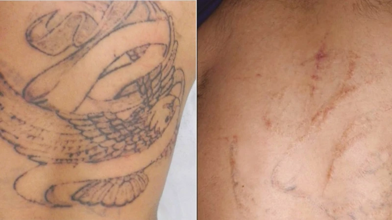 Types Of Tattoo Removal