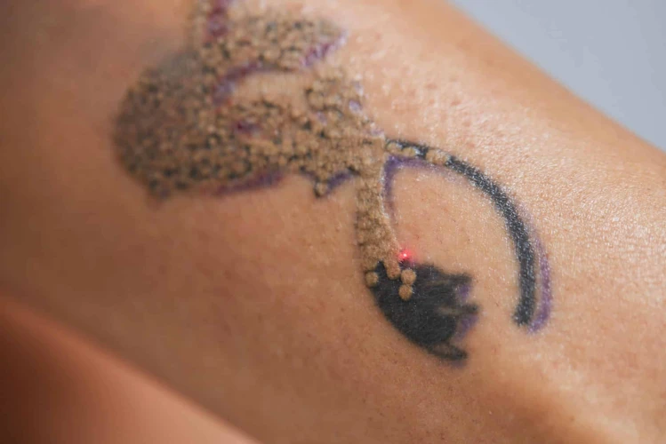 What Are The Risks Of Tattoo Removal?