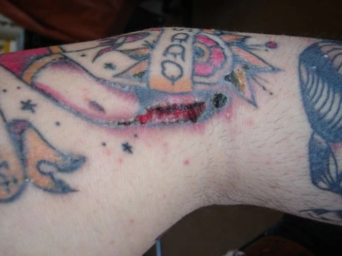 What Causes Tattoo Bruising?