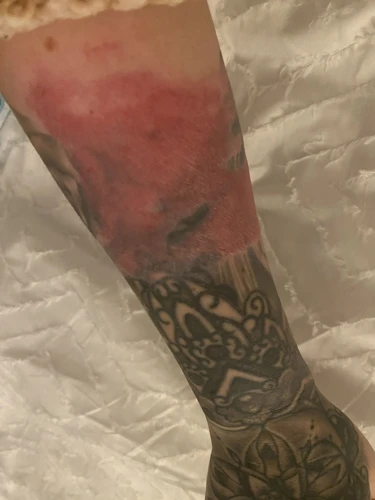 What Happens If You Burn A Tattoo?