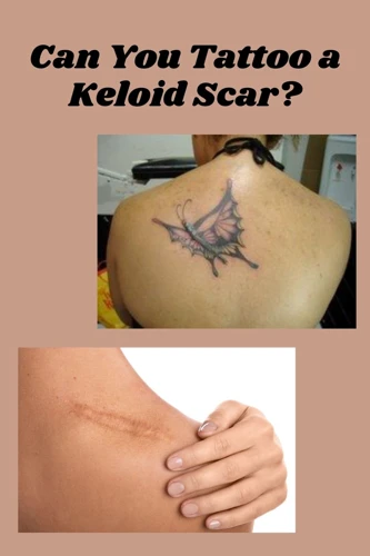 What Is A Keloid?
