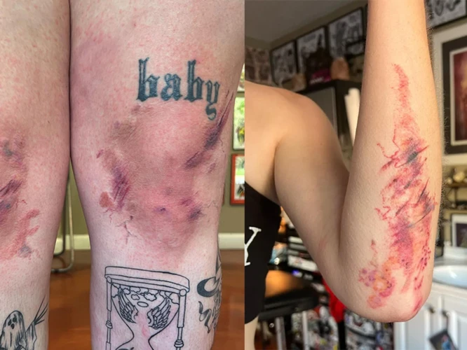 What Is Tattoo Bruising?