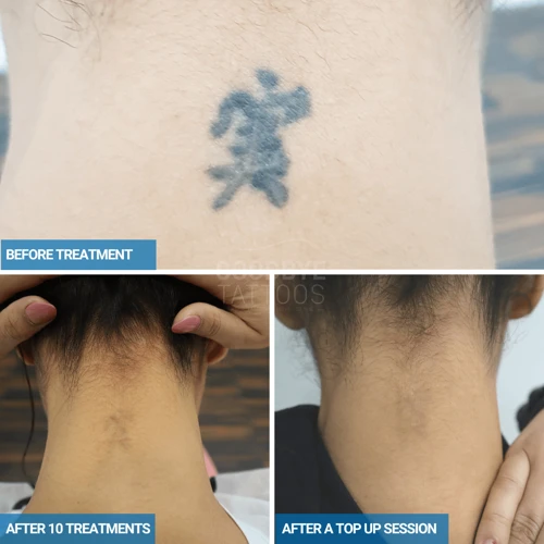 When Did Laser Tattoo Removal Start?