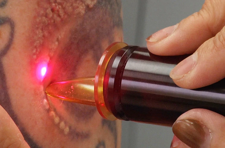 Who Invented Laser Tattoo Removal?
